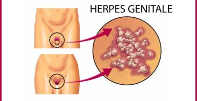 Il virus dell’herpes genitale
