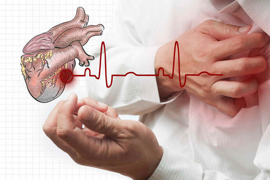 Infarto-del-miocardio-cosa-succede-al-cuore-igea-sant'antimo